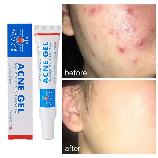 Effective Acne Removal Cream Anti-Acne Repair Redness Pimple Spots Gel Deep Cleaning Pore Oil Control Moisturizing Skin Care